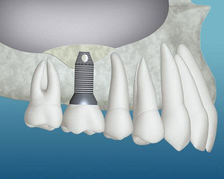 bone graft the villages fl|Bone Grafting in The Villages, FL .